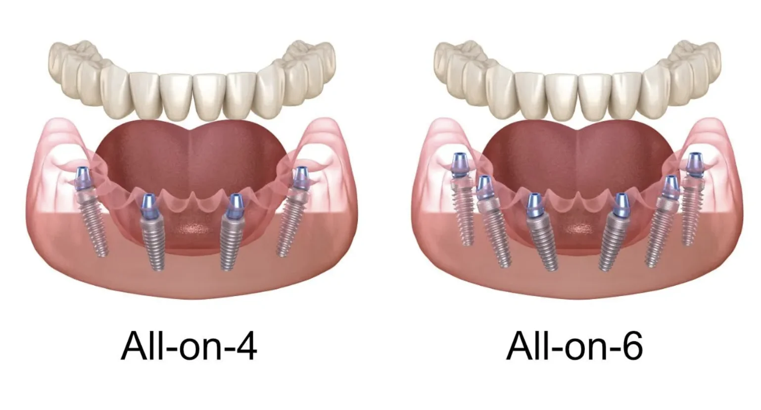 Protezavimas ant implantų